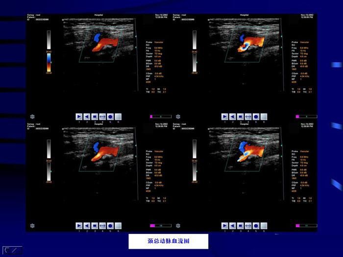 Sistema de diagnóstico ultrasónico de Doppler de color CMS1800 